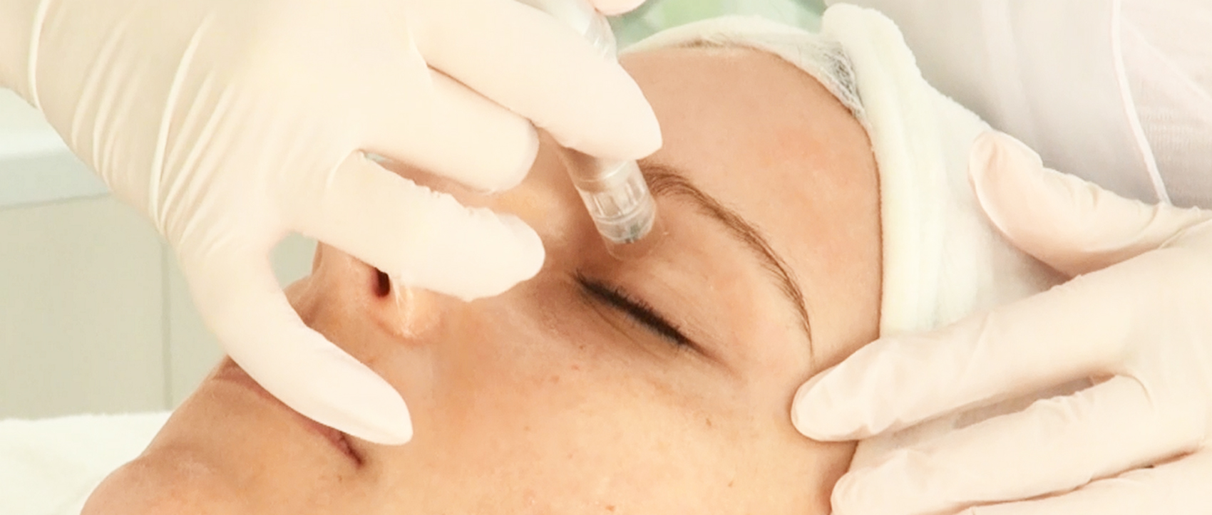 Micro Needling Gesicht u. Hals Intensiv -Behandlung