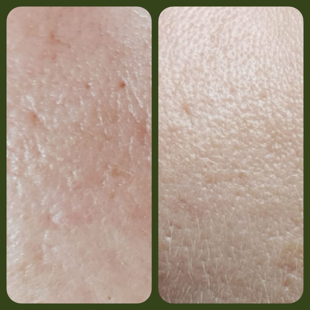 Fruchtsäure Peeling bei Entfaltung in Dortmund Marten entfaltung.de