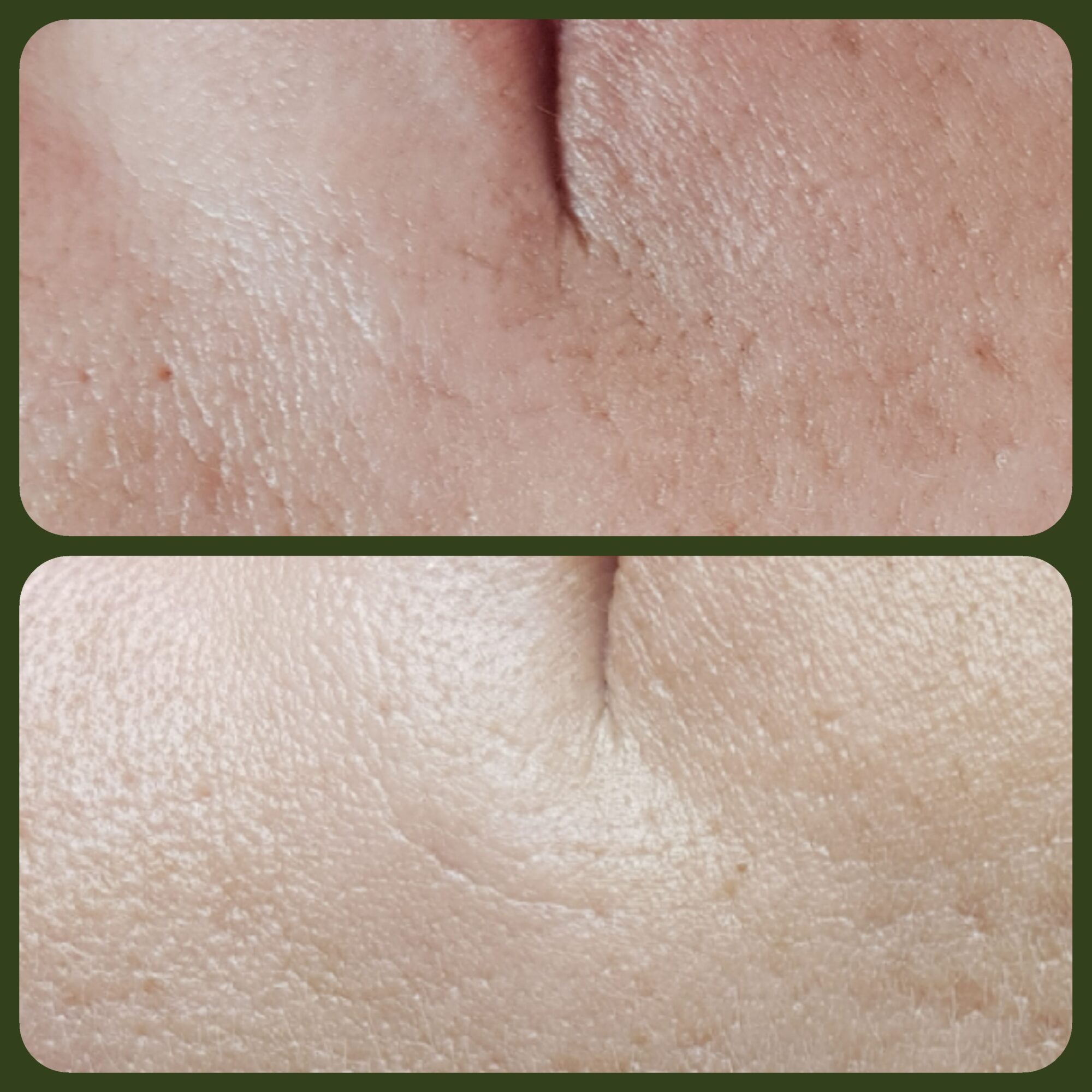 Fruchtsäure Peeling bei Entfaltung in Dortmund Marten entfaltung.de